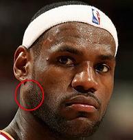 lebronjamesparotidtumor.jpg
